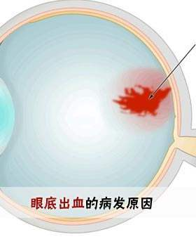 眼底黄斑出血最新治疗方法的研究与应用进展