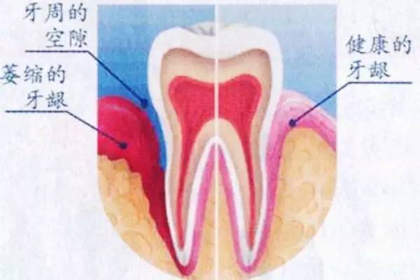 最新牙龈萎缩特效药研发进展及临床应用探索